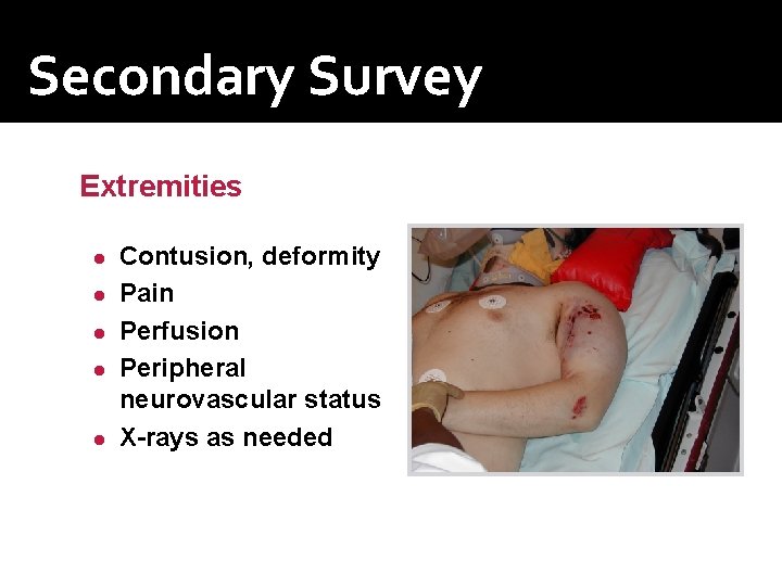 Secondary Survey Extremities ● ● ● Contusion, deformity Pain Perfusion Peripheral neurovascular status X-rays Secondary Survey Extremities ● ● ● Contusion, deformity Pain Perfusion Peripheral neurovascular status X-rays
