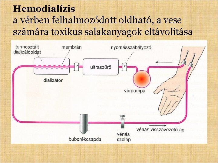 Hemodialízis a vérben felhalmozódott oldható, a vese számára toxikus salakanyagok eltávolítása 