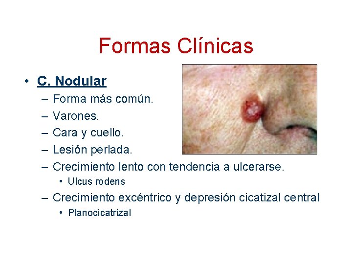 Formas Clínicas • C. Nodular – – – Forma más común. Varones. Cara y