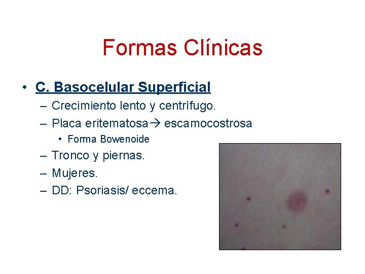 Formas Clínicas • C. Basocelular Superficial – Crecimiento lento y centrífugo. – Placa eritematosa