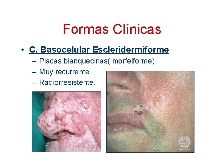 Formas Clínicas • C. Basocelular Escleridermiforme – Placas blanquecinas( morfeiforme) – Muy recurrente. –
