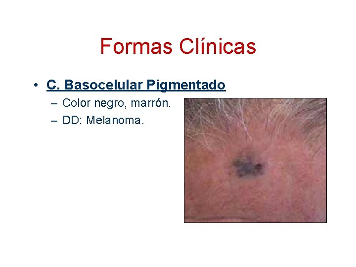 Formas Clínicas • C. Basocelular Pigmentado – Color negro, marrón. – DD: Melanoma. 