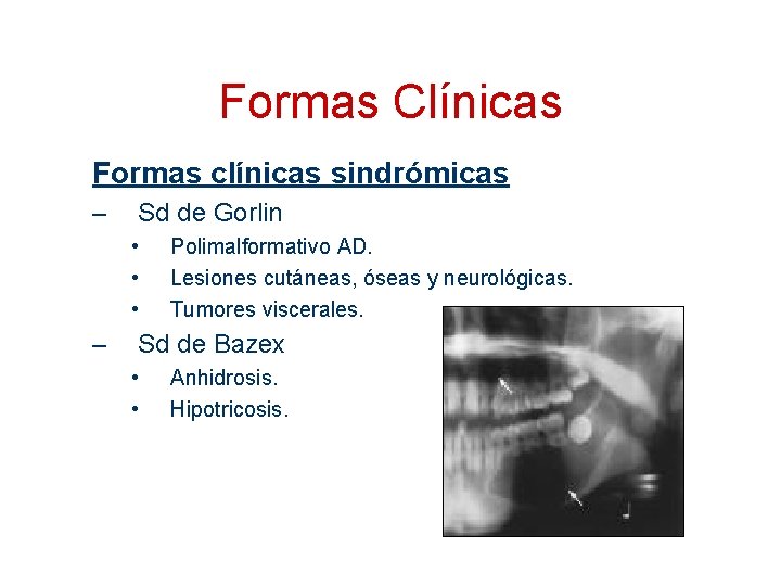 Formas Clínicas Formas clínicas sindrómicas – Sd de Gorlin • • • – Polimalformativo