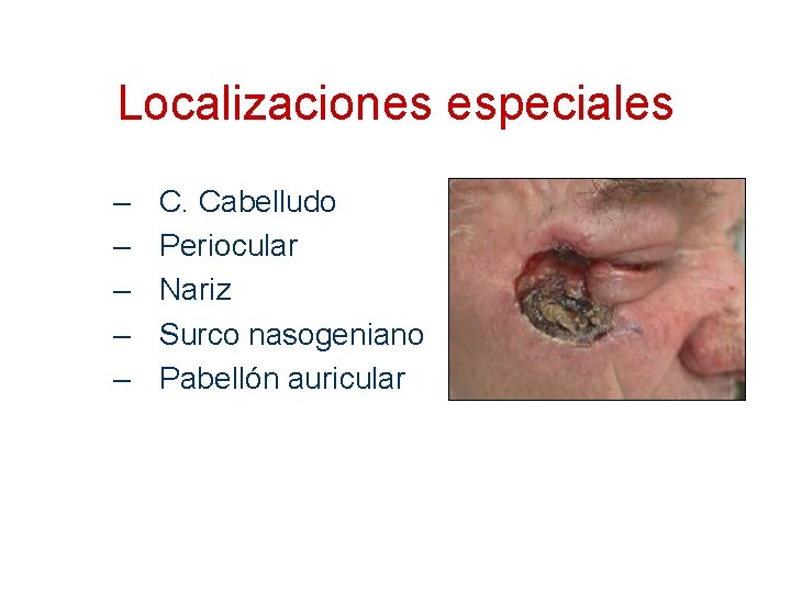 Localizaciones especiales – – – C. Cabelludo Periocular Nariz Surco nasogeniano Pabellón auricular 