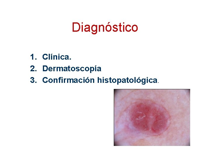 Diagnóstico 1. Clínica. 2. Dermatoscopía 3. Confirmación histopatológica. 