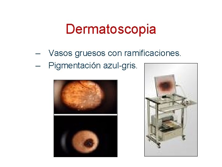 Dermatoscopia – Vasos gruesos con ramificaciones. – Pigmentación azul-gris. 