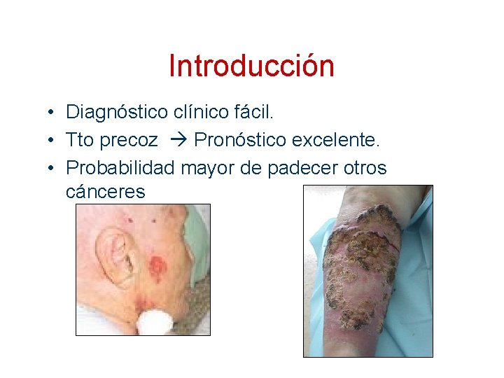 Introducción • Diagnóstico clínico fácil. • Tto precoz Pronóstico excelente. • Probabilidad mayor de