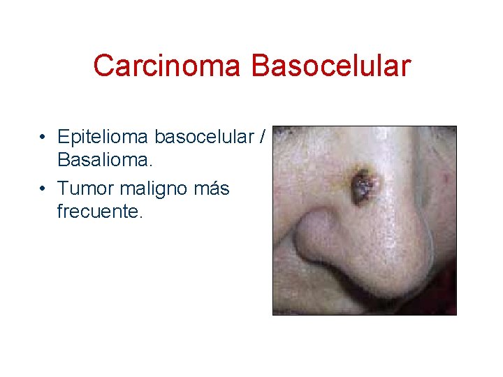 Carcinoma Basocelular • Epitelioma basocelular / Basalioma. • Tumor maligno más frecuente. 