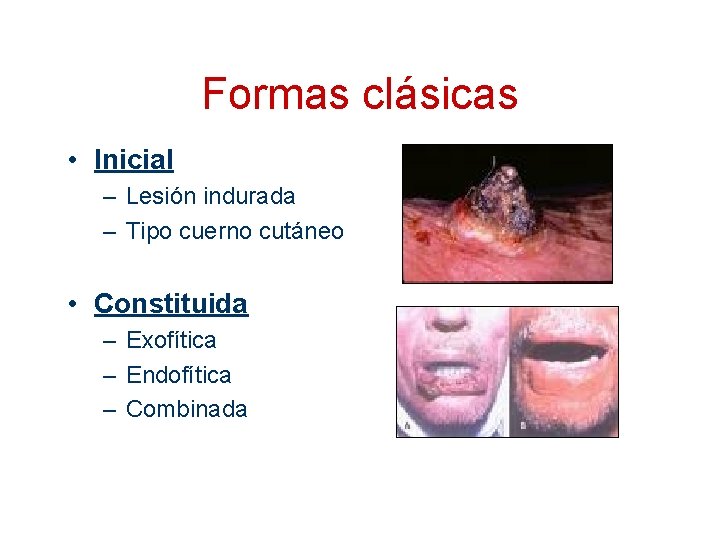Formas clásicas • Inicial – Lesión indurada – Tipo cuerno cutáneo • Constituida –