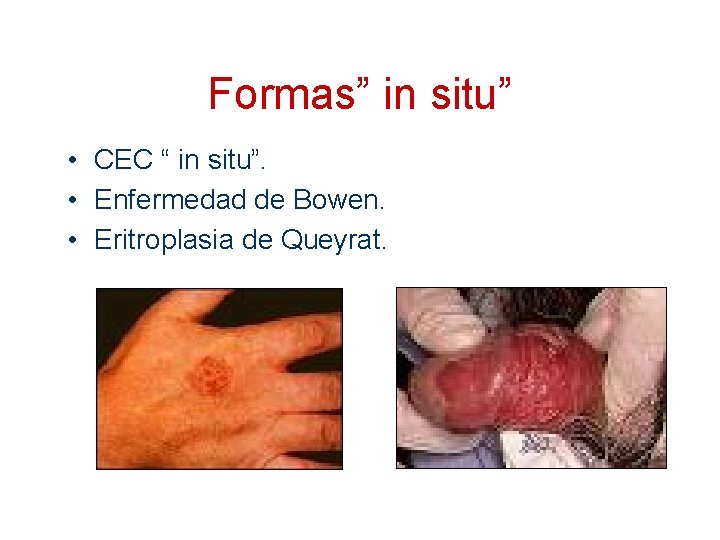 Formas” in situ” • CEC “ in situ”. • Enfermedad de Bowen. • Eritroplasia