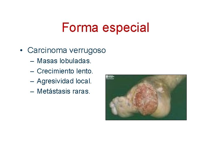 Forma especial • Carcinoma verrugoso – – Masas lobuladas. Crecimiento lento. Agresividad local. Metástasis