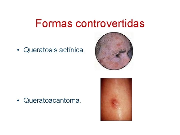 Formas controvertidas • Queratosis actínica. • Queratoacantoma. 