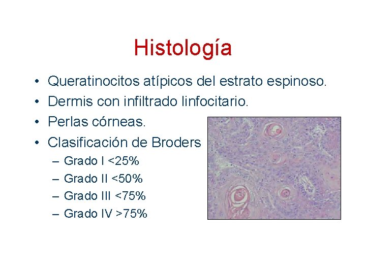 Histología • • Queratinocitos atípicos del estrato espinoso. Dermis con infiltrado linfocitario. Perlas córneas.