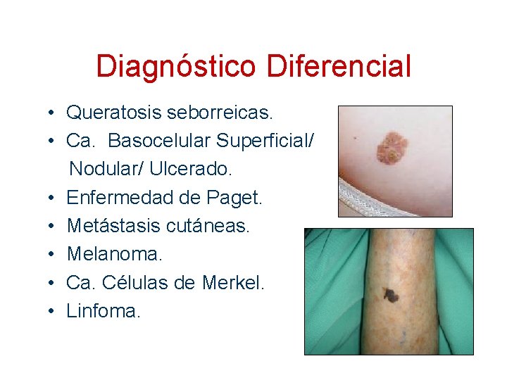 Diagnóstico Diferencial • Queratosis seborreicas. • Ca. Basocelular Superficial/ Nodular/ Ulcerado. • Enfermedad de