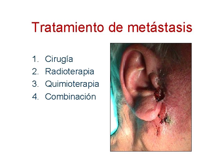 Tratamiento de metástasis 1. 2. 3. 4. Cirugía Radioterapia Quimioterapia Combinación 