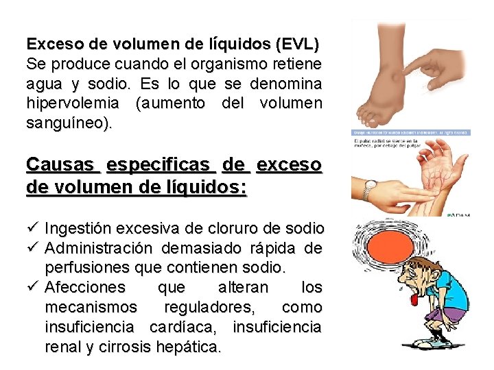 Exceso de volumen de líquidos (EVL) Se produce cuando el organismo retiene agua y