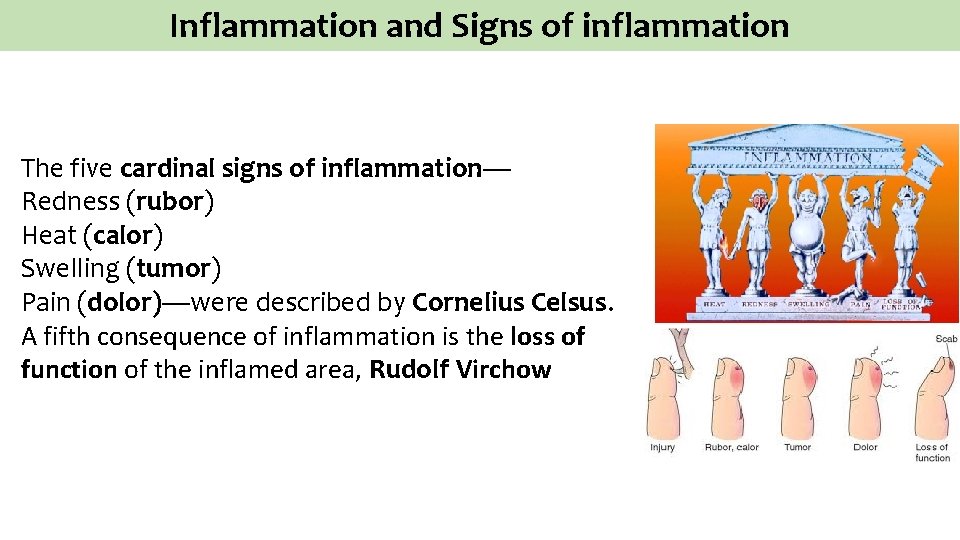 Inflammation and Signs of inflammation The five cardinal signs of inflammation— Redness (rubor) Heat
