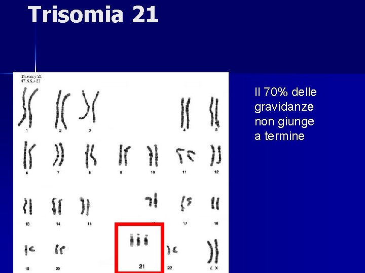 Trisomia 21 Il 70% delle gravidanze non giunge a termine 