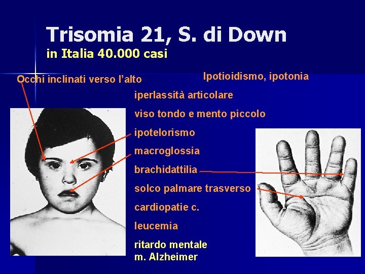 Trisomia 21, S. di Down in Italia 40. 000 casi Occhi inclinati verso l’alto