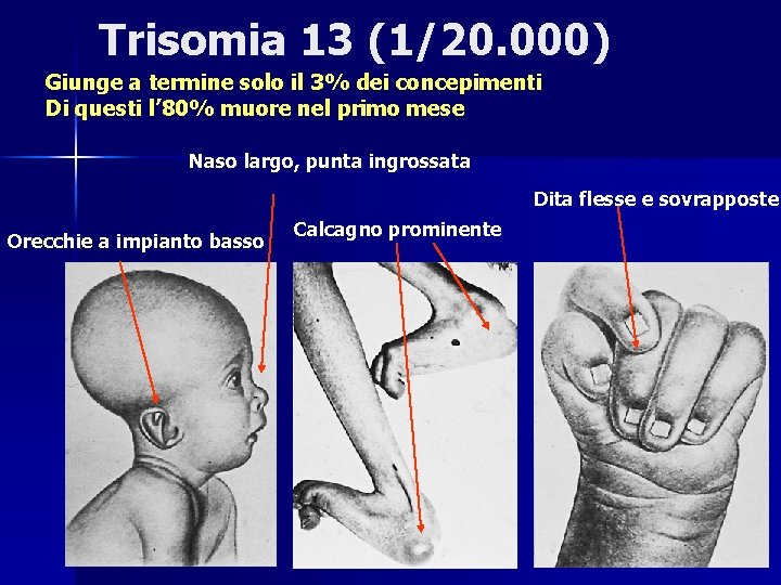 Trisomia 13 (1/20. 000) Giunge a termine solo il 3% dei concepimenti Di questi