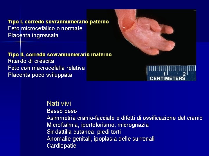 Tipo I, corredo sovrannumerario paterno Feto microcefalico o normale Placenta ingrossata Tipo II, corredo