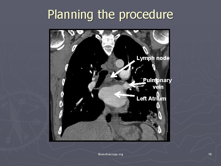 Planning the procedure Lymph node Pulmonary vein Left Atrium Bronchoscopy. org 18 Planning the procedure Lymph node Pulmonary vein Left Atrium Bronchoscopy. org 18