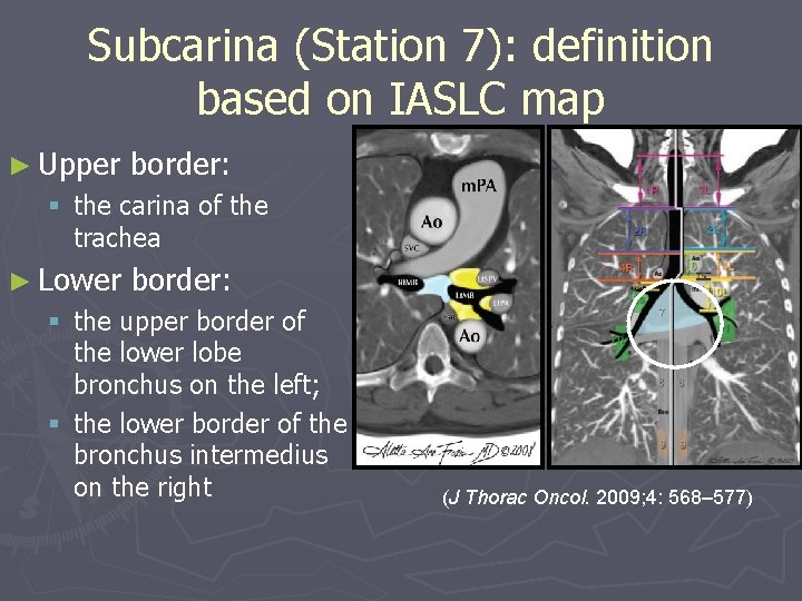 Subcarina (Station 7): definition based on IASLC map ► Upper border: § the carina Subcarina (Station 7): definition based on IASLC map ► Upper border: § the carina