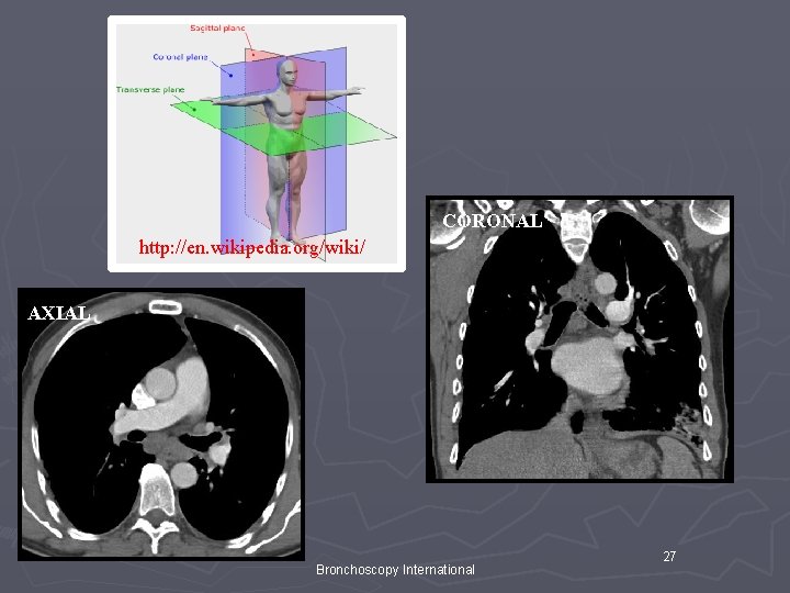 CORONAL http: //en. wikipedia. org/wiki/ AXIAL Bronchoscopy International 27 CORONAL http: //en. wikipedia. org/wiki/ AXIAL Bronchoscopy International 27