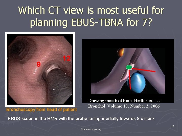 Which CT view is most useful for planning EBUS-TBNA for 7? 9 12 Bronchoscopy Which CT view is most useful for planning EBUS-TBNA for 7? 9 12 Bronchoscopy