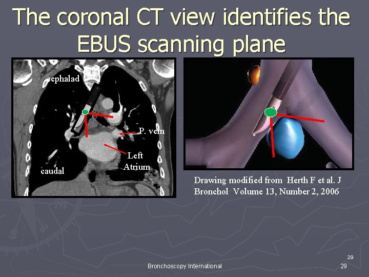 The coronal CT view identifies the EBUS scanning plane cephalad LN caudal P. vein The coronal CT view identifies the EBUS scanning plane cephalad LN caudal P. vein