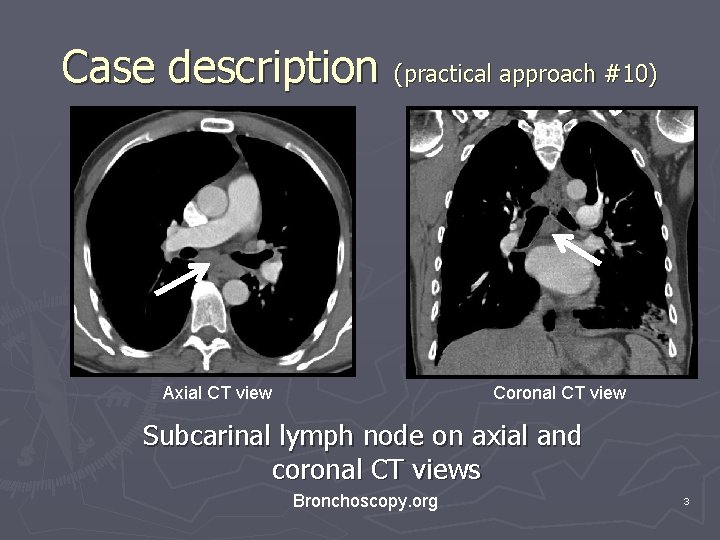 Case description (practical approach #10) Axial CT view Coronal CT view Subcarinal lymph node Case description (practical approach #10) Axial CT view Coronal CT view Subcarinal lymph node