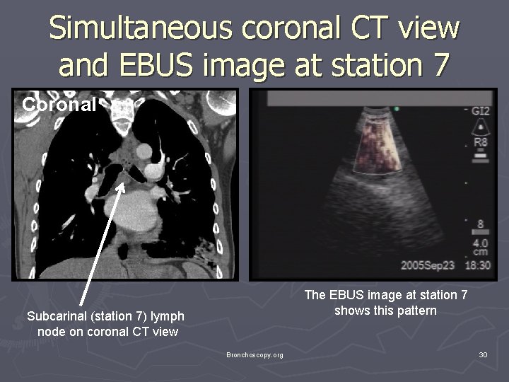 Simultaneous coronal CT view and EBUS image at station 7 Coronal The EBUS image Simultaneous coronal CT view and EBUS image at station 7 Coronal The EBUS image