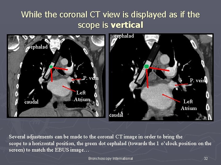 While the coronal CT view is displayed as if the scope is vertical cephalad While the coronal CT view is displayed as if the scope is vertical cephalad