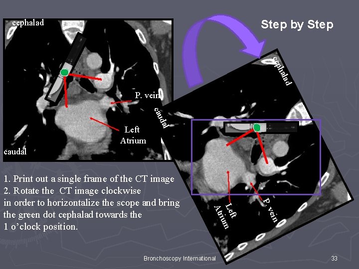 cephalad Step by Step d a hal cep P. vein al d cau Left cephalad Step by Step d a hal cep P. vein al d cau Left