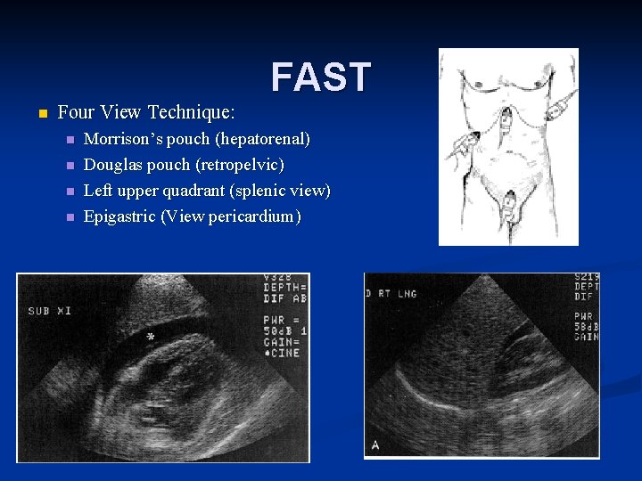 FAST n Four View Technique: n n Morrison’s pouch (hepatorenal) Douglas pouch (retropelvic) Left