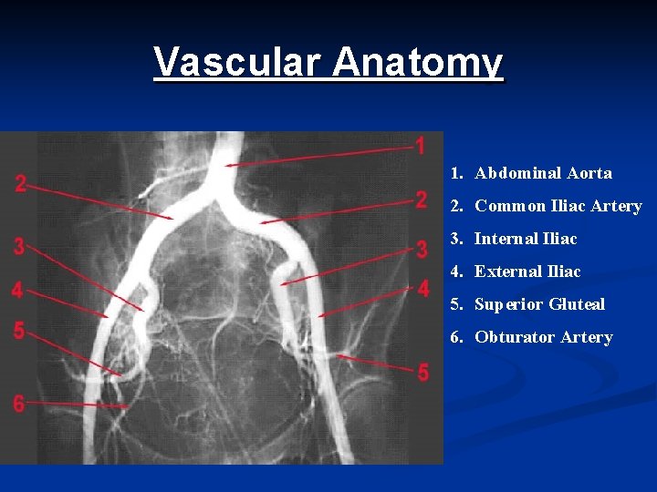 Vascular Anatomy 1. Abdominal Aorta 2. Common Iliac Artery 3. Internal Iliac 4. External