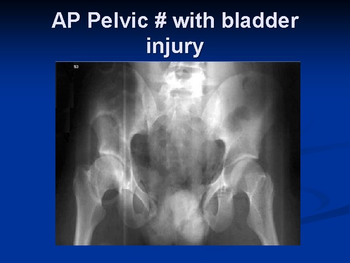 AP Pelvic # with bladder injury 
