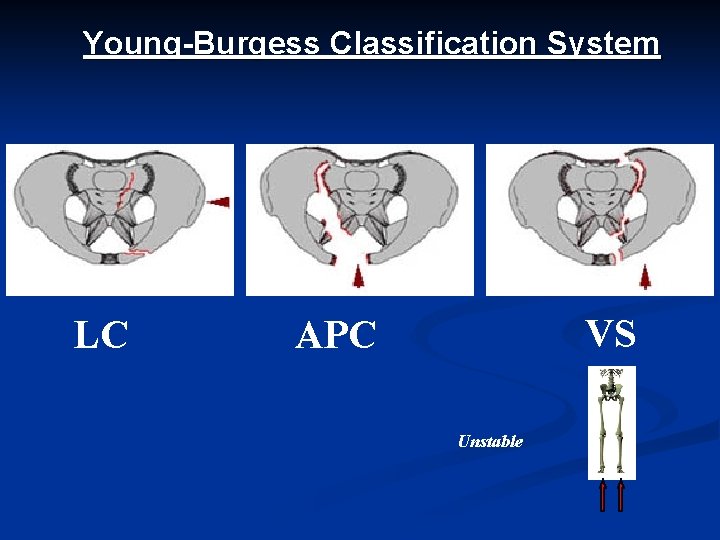 Young-Burgess Classification System LC VS APC Unstable 