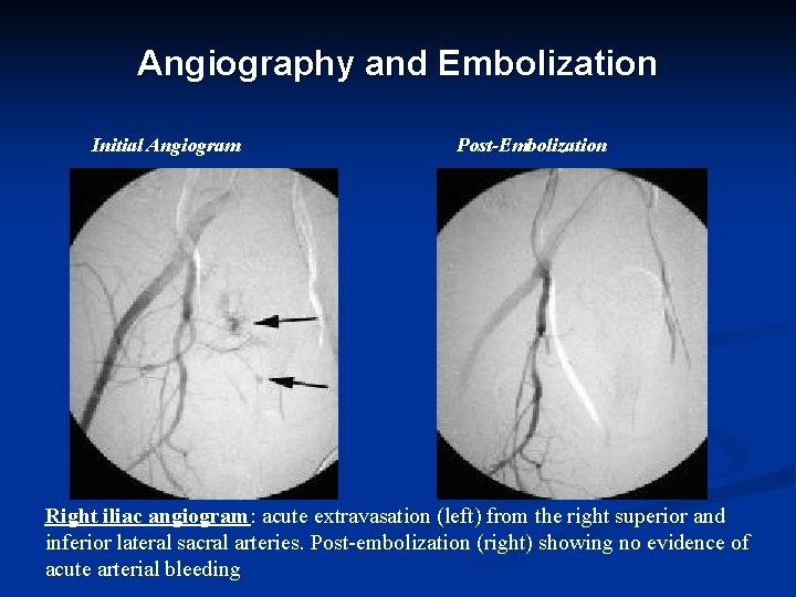 Angiography and Embolization Initial Angiogram Post-Embolization Right iliac angiogram: acute extravasation (left) from the