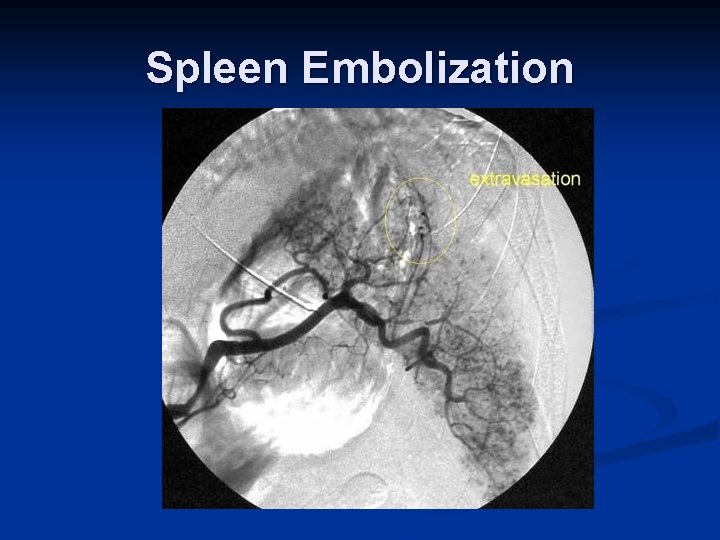 Spleen Embolization 