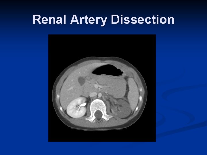 Renal Artery Dissection 