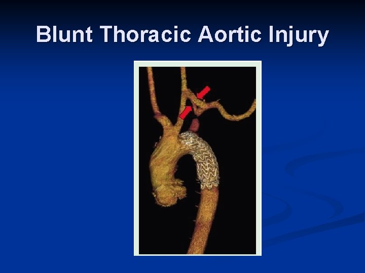 Blunt Thoracic Aortic Injury 