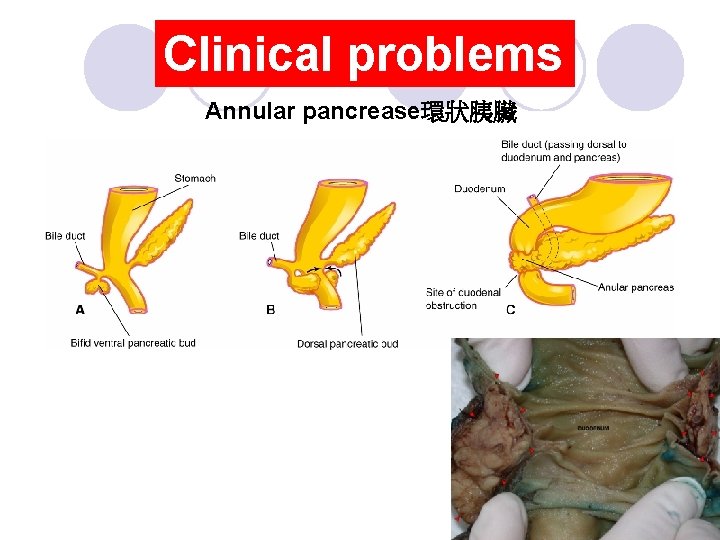 Clinical problems Annular pancrease環狀胰臟 