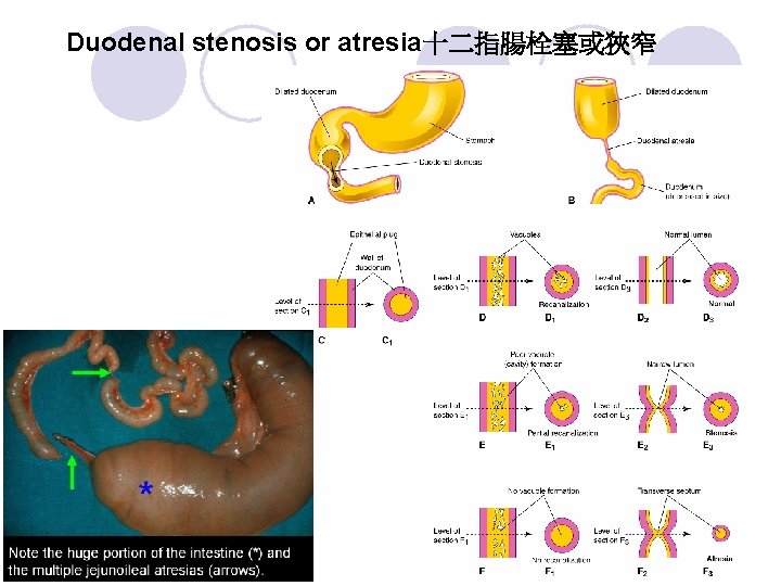 Duodenal stenosis or atresia十二指腸栓塞或狹窄 