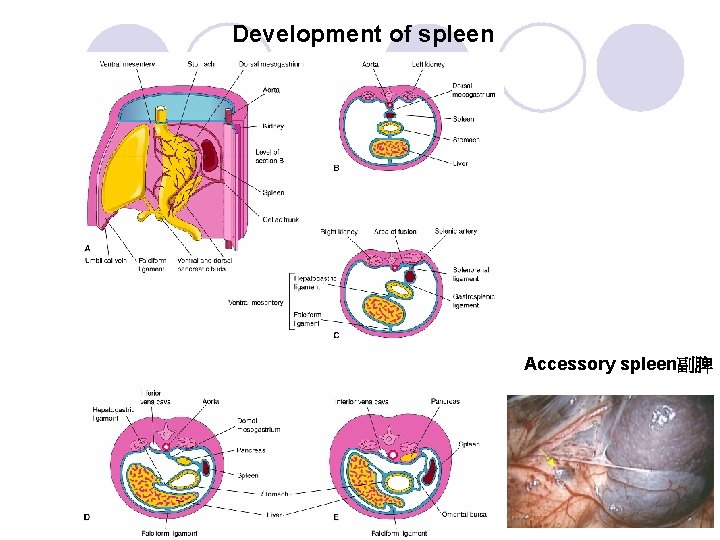 Development of spleen Accessory spleen副脾 