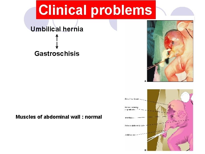 Clinical problems Umbilical hernia ↑ ↓ Gastroschisis Muscles of abdominal wall : normal 