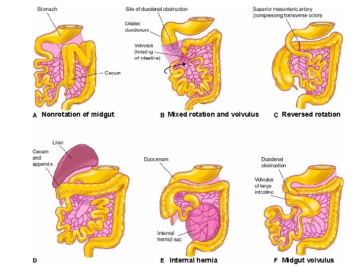 Nonrotation of midgut Mixed rotation and volvulus Internal hernia Reversed rotation Midgut volvulus 