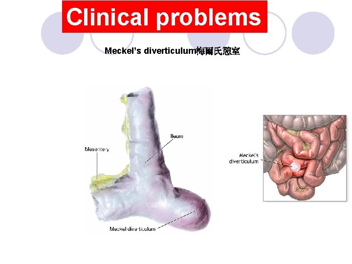 Clinical problems Meckel’s diverticulum梅爾氏憩室 