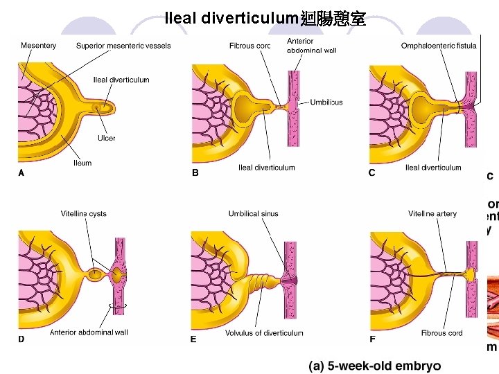 Ileal diverticulum迴腸憩室 