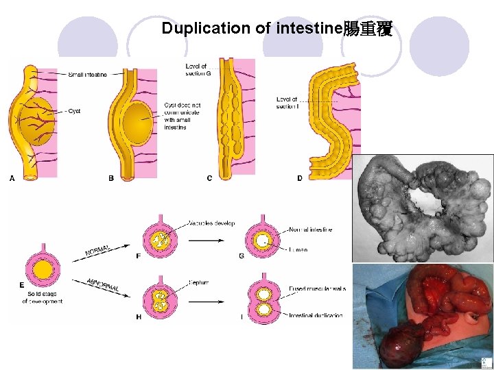 Duplication of intestine腸重覆 